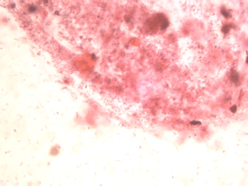 1000 times magnification dientamoeba fragilis, a protozoan parasite